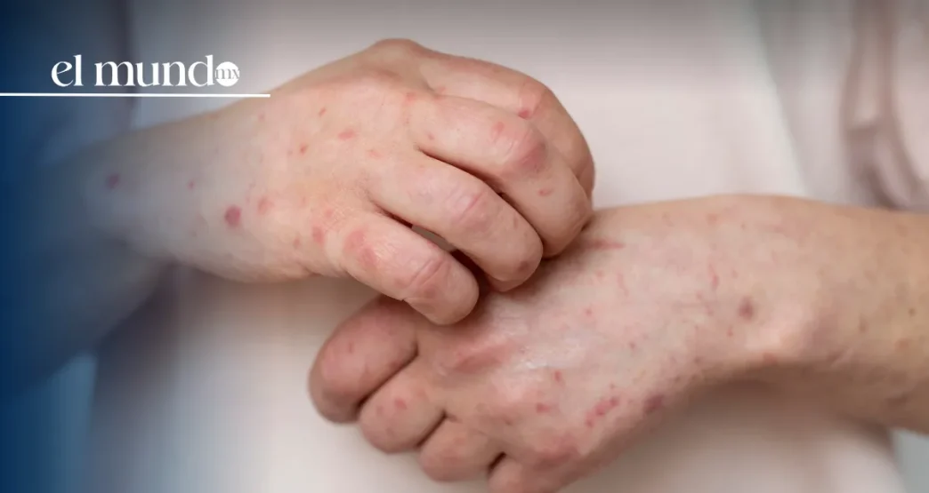 Sedesa activa alerta por sarampión en CDMX