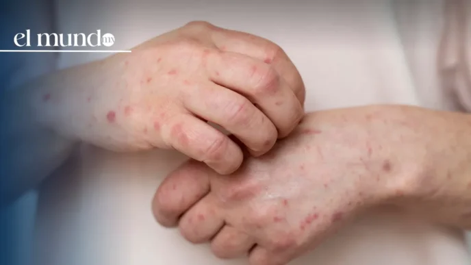 Sedesa activa alerta por sarampión en CDMX