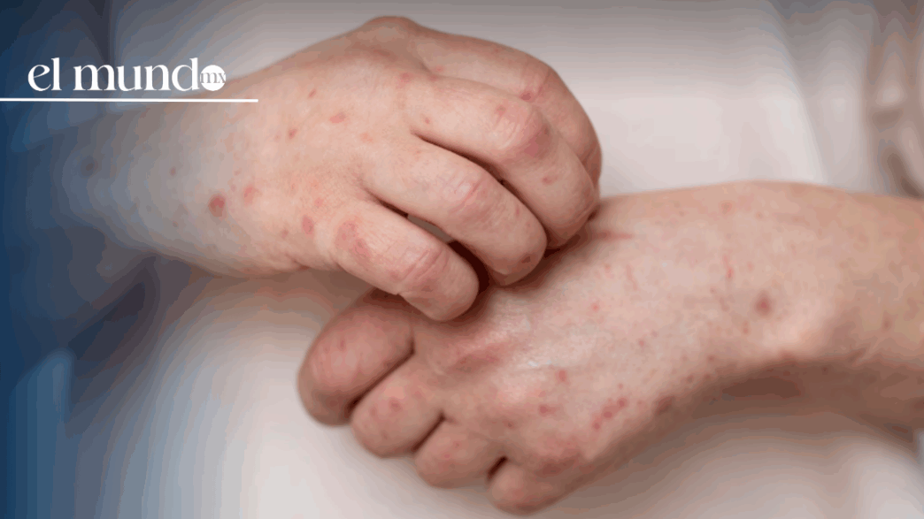 Sarampión en México 2026